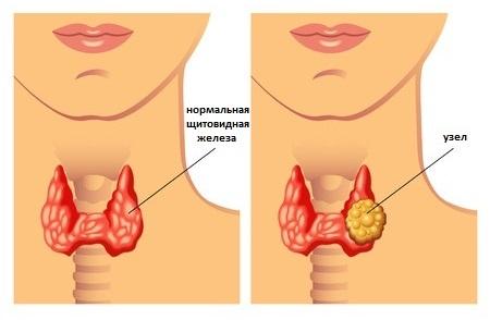 Фото признаки заболевания щитовидной железы симптомы и лечение