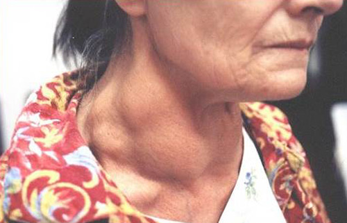 Как проявляет себя щитовидная железа лечение