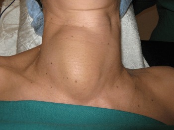 Причины болезни щитовидной железы у женщин симптомы