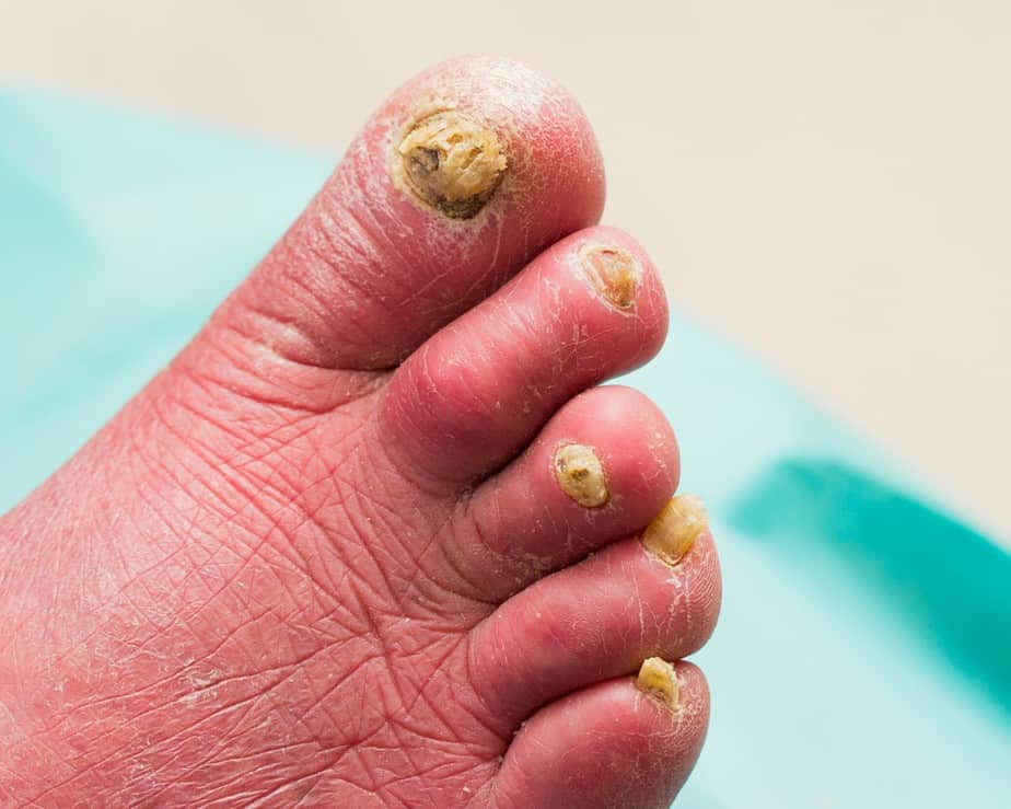 Чем лечить грибок ногтей на ногах: народные средства, препараты