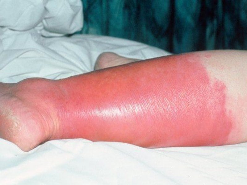 Рожистое воспаление ноги1