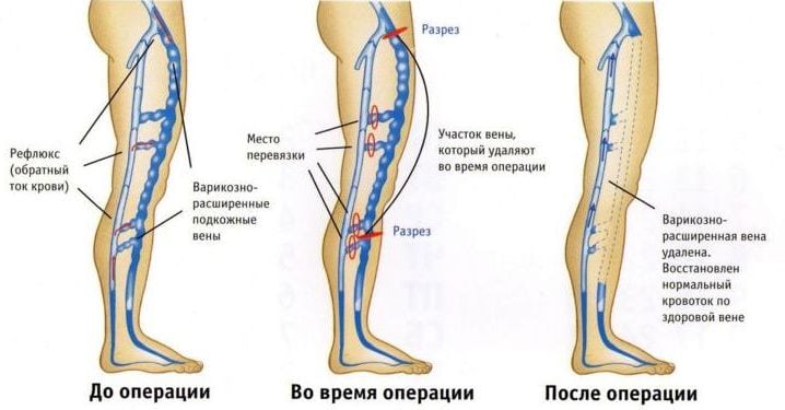 Как выглядит тромб на ноге фото симптомы и лечение
