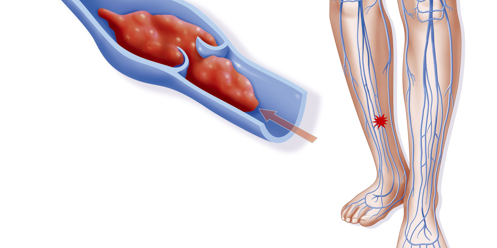 Как выглядит тромб на ноге фото симптомы и лечение у взрослых