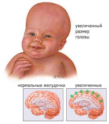 Гидроцефалия у новорожднных разновидности и симптомы заболевания возможные осложнения болезни