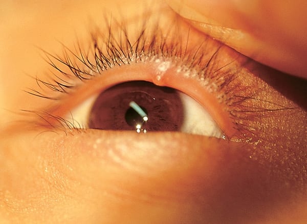 Как вылечить хронический ячмень на глазу