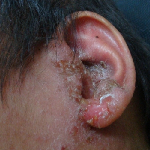 2. atopicheskiy dermatit