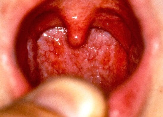 Как выглядит болезнь ангина фото thumbnail