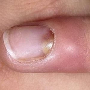 Димексид при панариции пальца 18