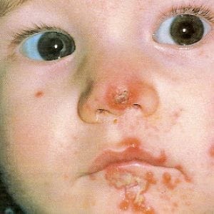 Стрептодермия у детей фото лечение в домашних