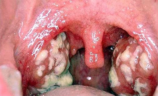 Симптомы ангины у ребенка фото thumbnail