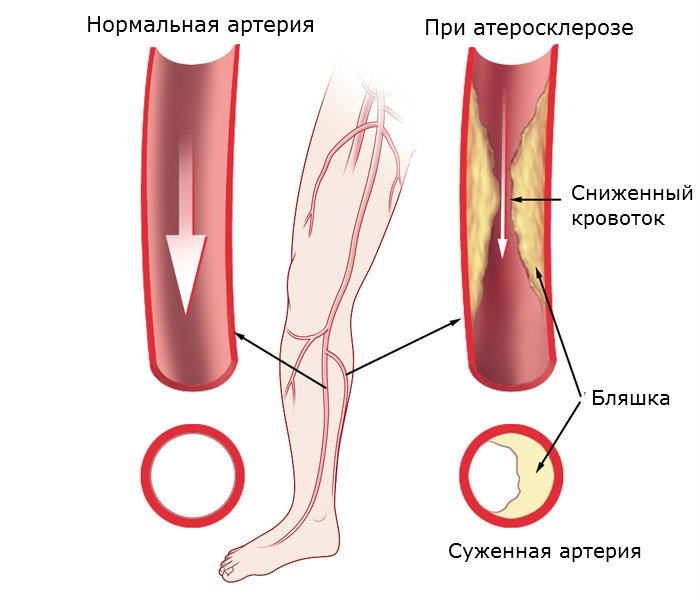 Атеросклероз конечностей ног фото