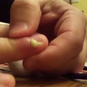 Димексид при панариции пальца 19