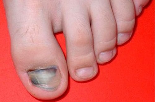Внутренняя гематома на ноге после ушиба фото thumbnail