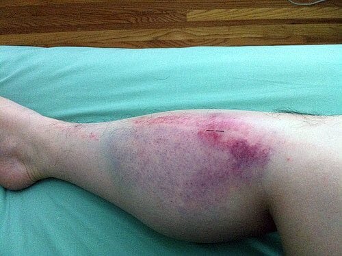 Синяк на ноге лечение фото thumbnail