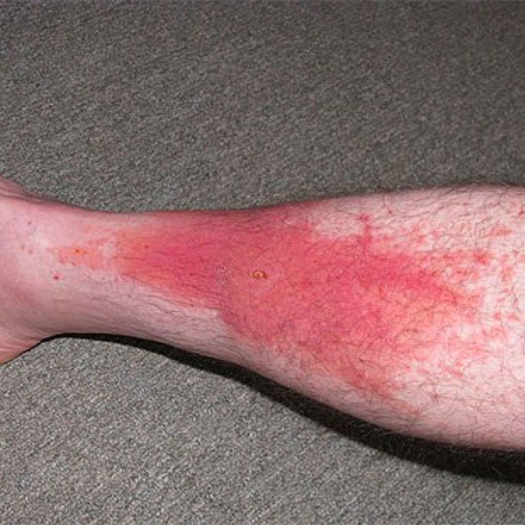 Сильная гематома на ноге лечение фото