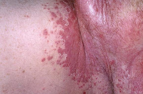 Аллергия в области паха у мужчин thumbnail