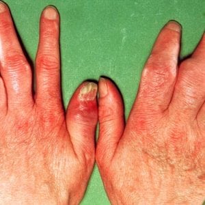 Сколько живут с псориатическим артритом