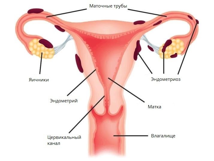 ЭНДОМЕТРИОЗ ⁂ симптомы эндометриоза матки, шейки ▷ фото ▷