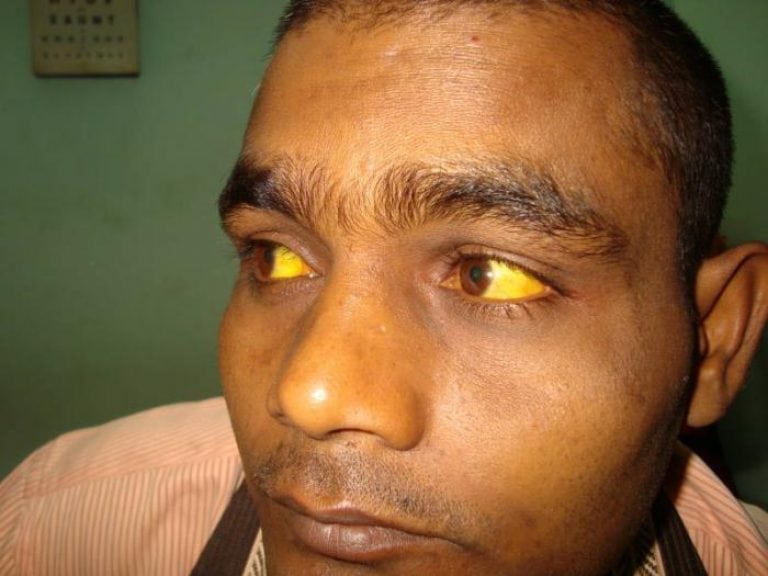 Желтый человек какая болезнь. Желтые глаза.