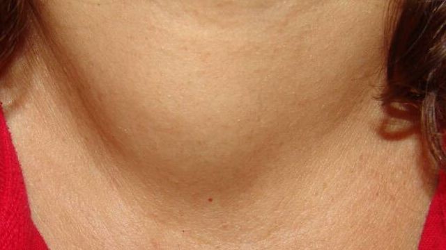АИТ щитовидной железы: лечение I История одного человека