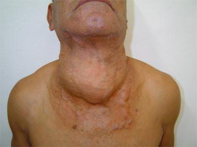Вялая щитовидная железа лечение