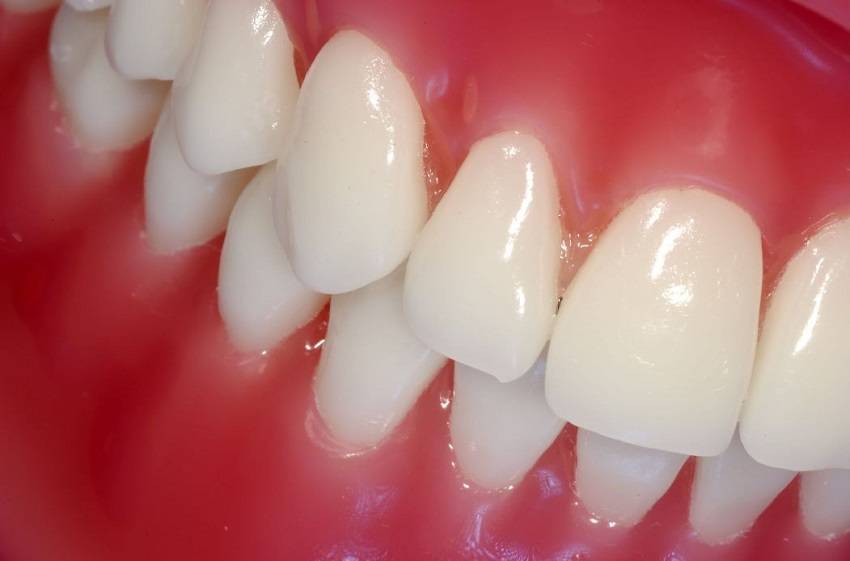 Как вылечить воспаление десен зуба