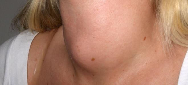 Лечение при проблемах с щитовидной железой у женщин