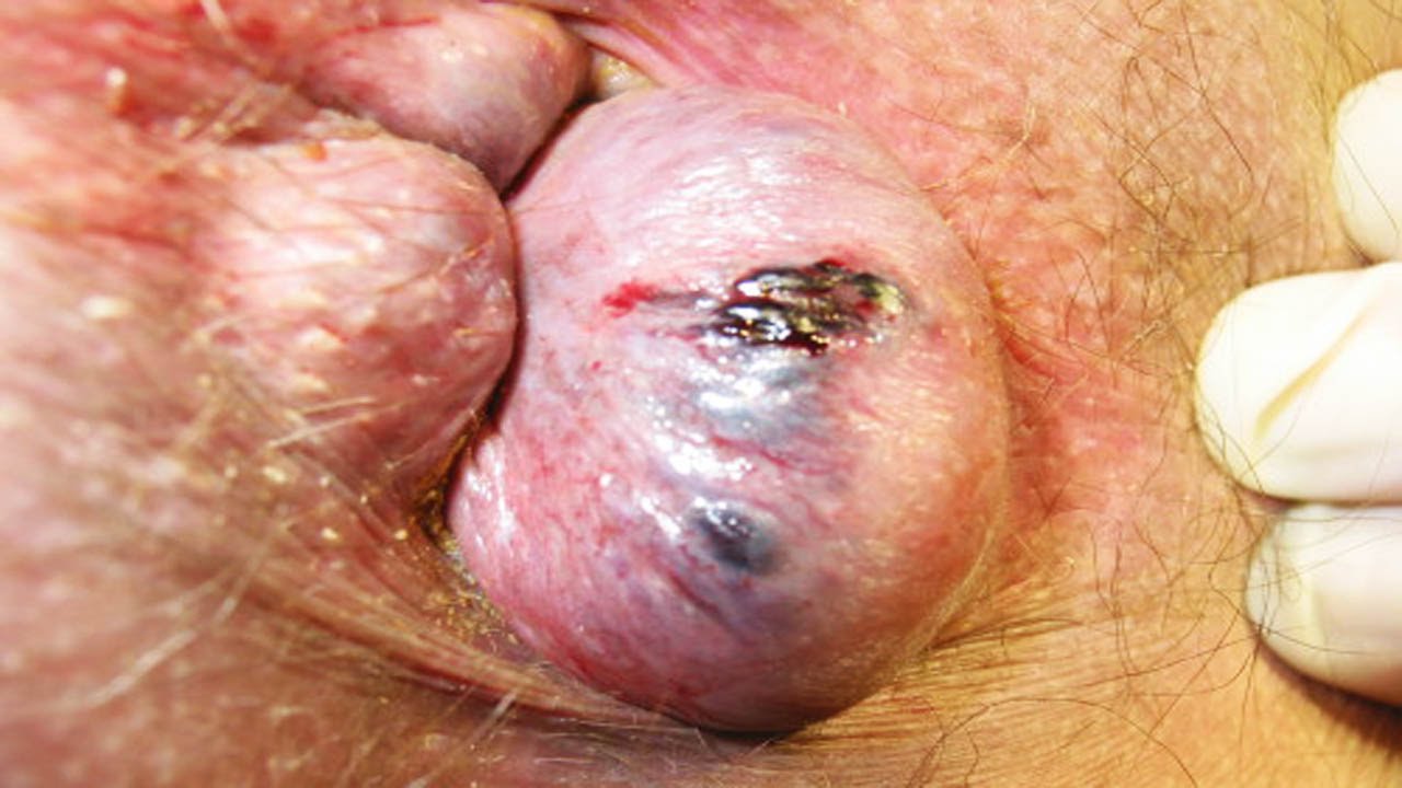 Геморрой внутренний начальная стадия симптомы thumbnail