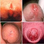 Хламидиоз у женщин симптомы и лечение в домашних фото