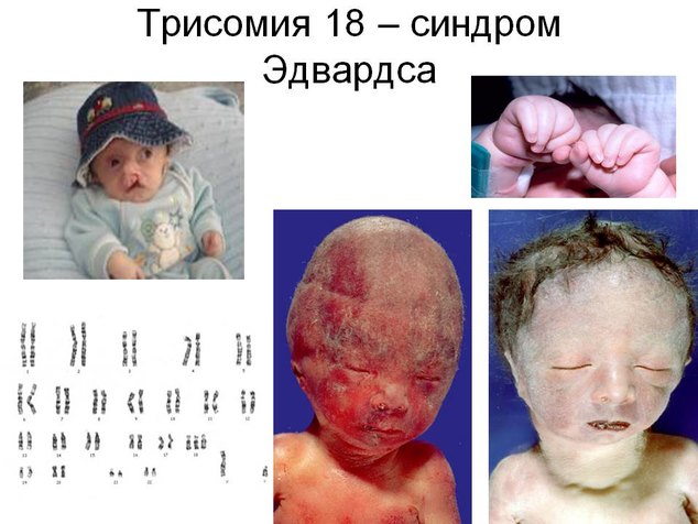 Дети с синдромом эдвардса фото новорожденных