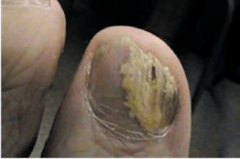 Короткий ноготь на большом пальце руки болезнь