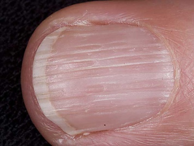 Фото болезней ногтей рук в руки