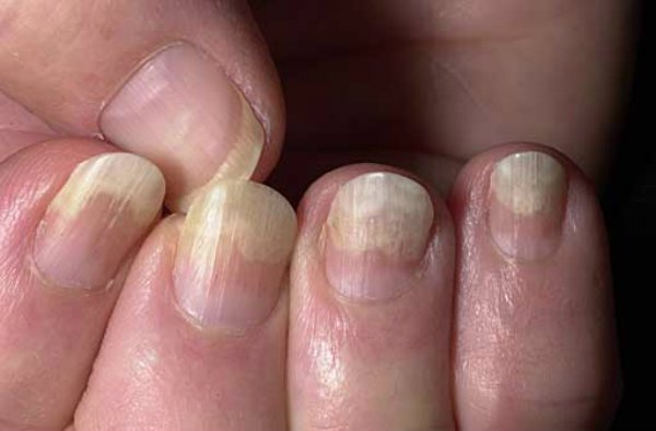 Болезнь ногтей на руках у мужчин