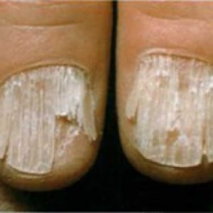 Определить болезни по ногтевой пластине с фото 127