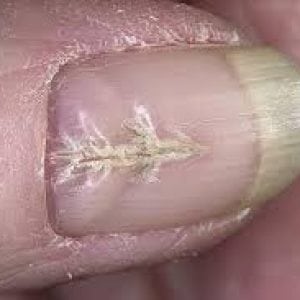 Определить болезни по ногтевой пластине с фото 115