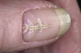 Анемия ногтей на руках