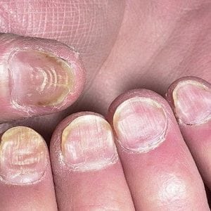 Определить болезни по ногтевой пластине с фото 104