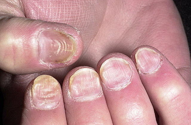 А каких болезнях в основании ногтя