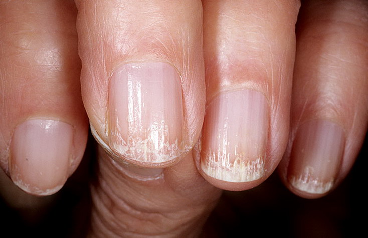 Фото ногтей по которым можно определить болезнь