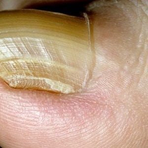 Определить болезни по ногтевой пластине с фото 95