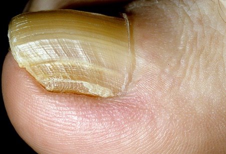 Виды болезней ногтей на ногах фото