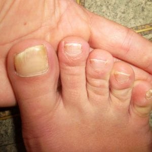Определить болезни по ногтевой пластине с фото 102