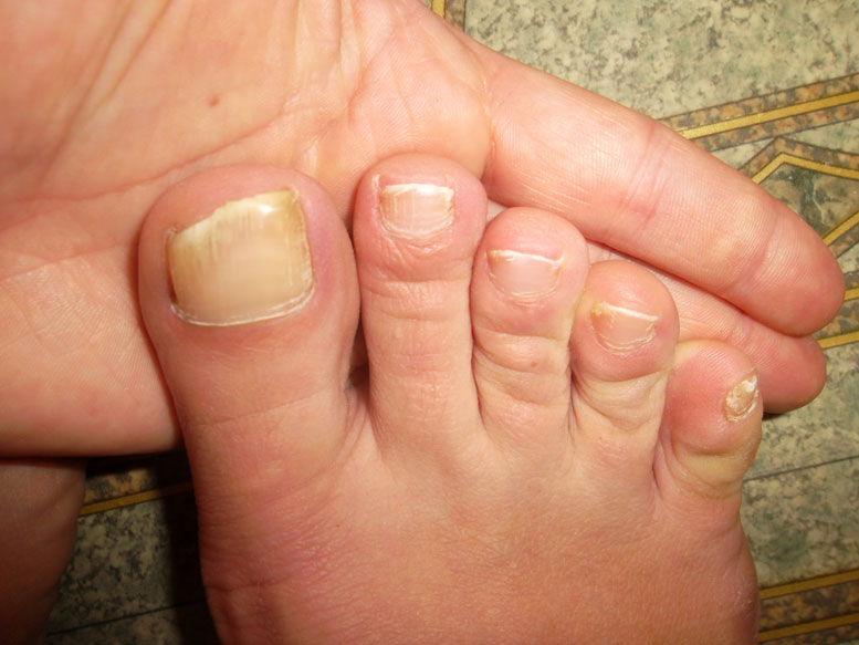 Болезнь кожи вокруг ногтей рук
