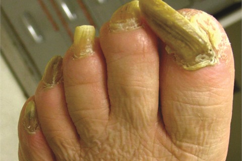 Болезнь ногтей на руках у мужчин