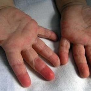 Красные пятна на теле у ребенка все о причинах патологии и способах лечения