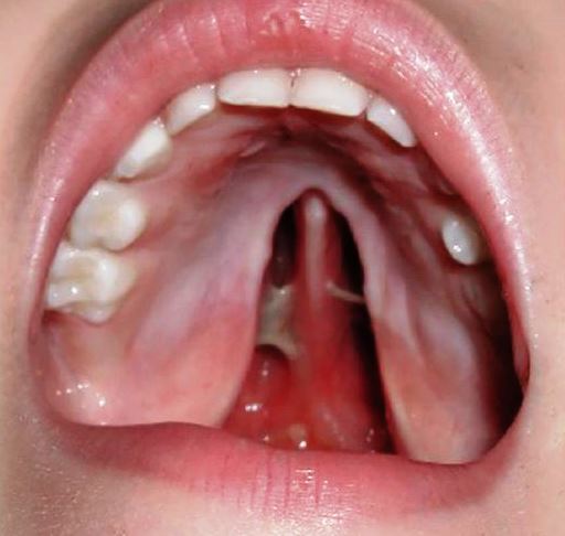 Синдром волчьей пасти и заячьей губы