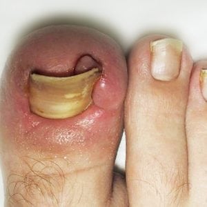 Заболевания ногтей на ногах фото и описание лечение
