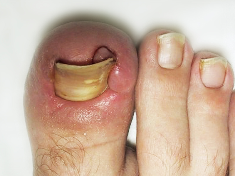 Болезнь ногтей на ногах фото и название болезни