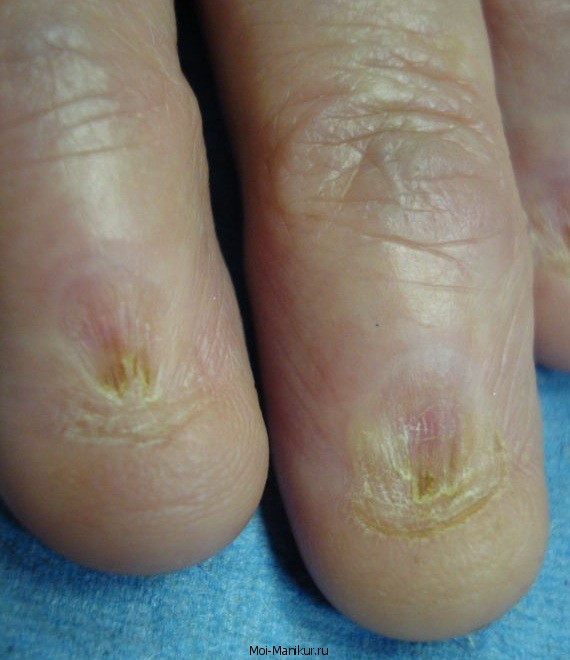 Травмы и болезни ногтей на руках
