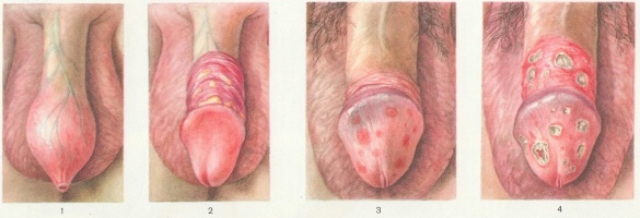 Триперная болезнь у мужчин лечение фото